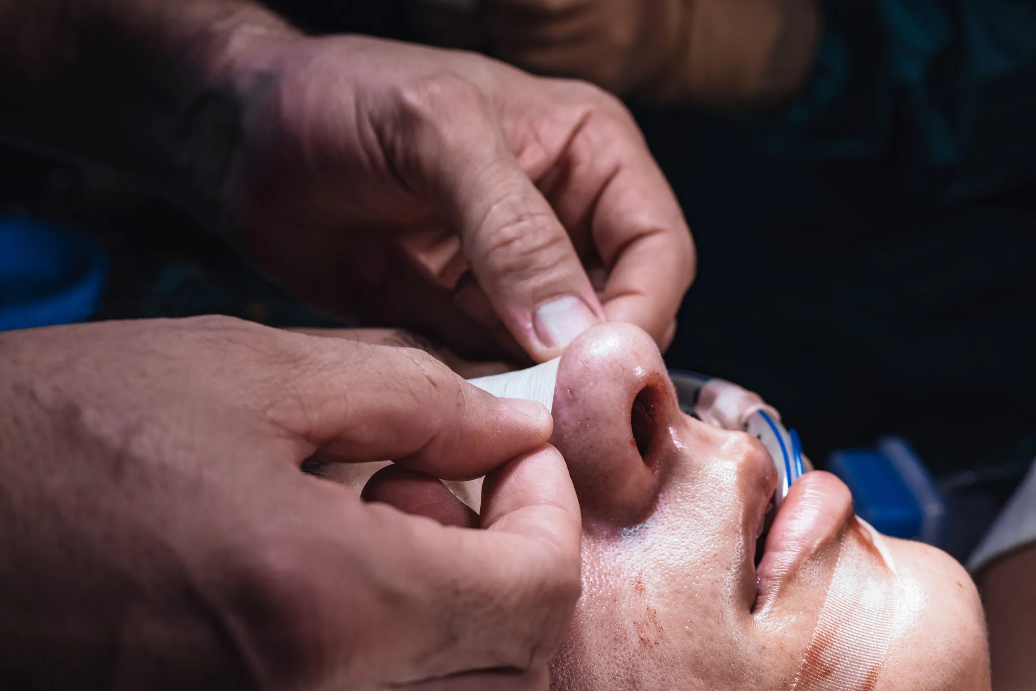 Χειρουργικοί χειρισμοί κατά τη ρινοπλαστική